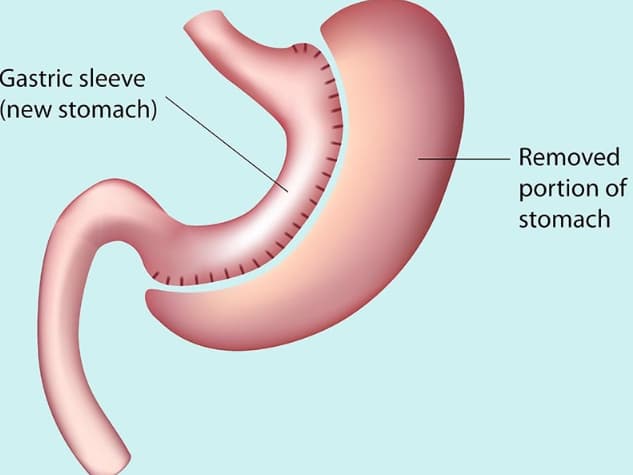 Gastric Sleeve Surgery