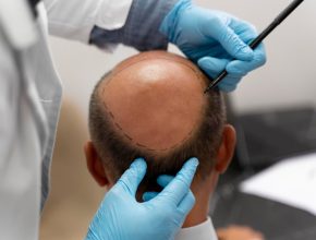 Enhancing Your Appearance Beyond the Scalp for Transformation