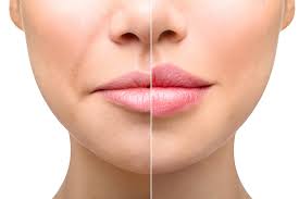 Dermal Fillers