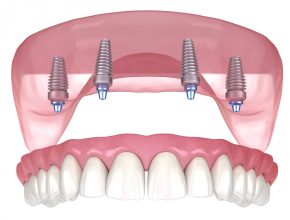 Benefits of All-on-4 Dental Implants