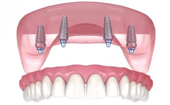 Benefits of All-on-4 Dental Implants