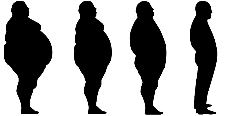 Diet Progression After Bariatric Surgery