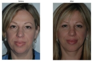 Revision Rhinoplasty: Incorporating Patients own Bone and Cartilage
