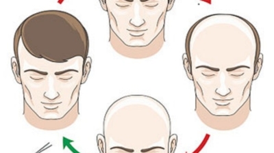 7 Ways Of How A Hair Transplant Can Positively Affect Your Life