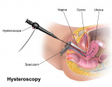 Hysteroscopy: What You Should Know?