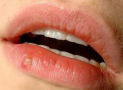 7 Ways to Manage Genital Herpes