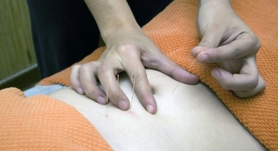 The Benefits of Permanent Acupuncture Treatment