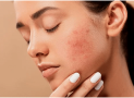 Proven Ways to Fight Acne