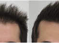Avail the Best Hair Transplant in Chennai And Get The Best Result
