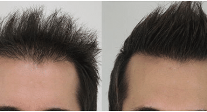 Avail the Best Hair Transplant in Chennai And Get The Best Result