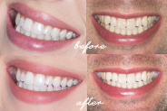 White Light Smile Reviews – Don’t Buy WiThout ReaD