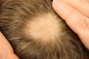 Follixin Review – Not a Real Hair Loss Treatment?