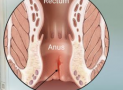 Anal Fissure: Symptoms, Treatment, Relief, and Cure