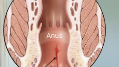 Anal Fissure: Symptoms, Treatment, Relief, and Cure