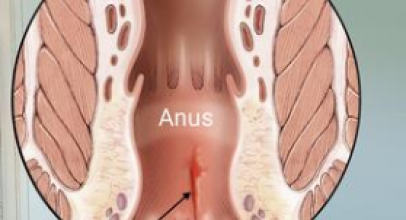 Anal Fissure: Symptoms, Treatment, Relief, and Cure