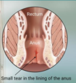 Anal Fissure: Symptoms, Treatment, Relief, and Cure