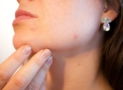 How to Treat Acne with Retinoid Adapalene?