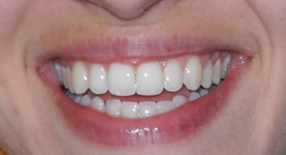 How to Have Healthier and Better Teeth