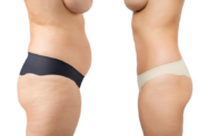 Liposuction Treatment: A Great Way to enhance the shape & Contour of These Body Parts