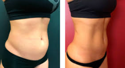 Emsculpt Treatment: Process, price, and risk