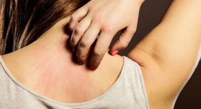 What causes Scabies – Symptoms & Treatment Explained